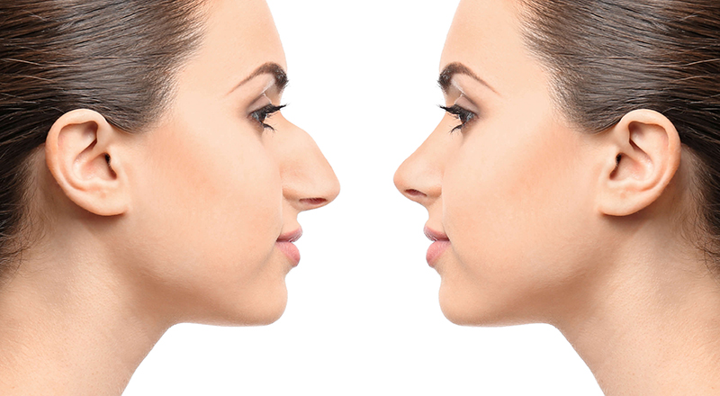 Can a 17-Year-Old Get a Rhinoplasty?