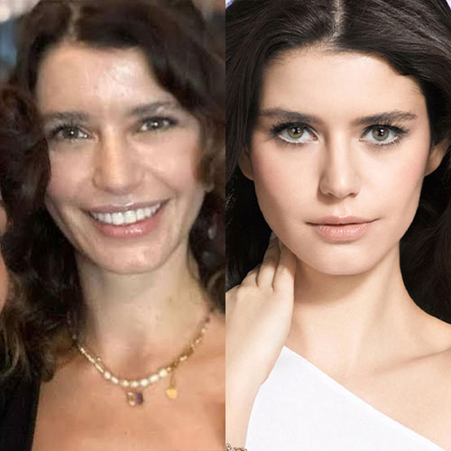 beren saat burun estetigi