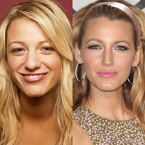 blake lively burun estetigi