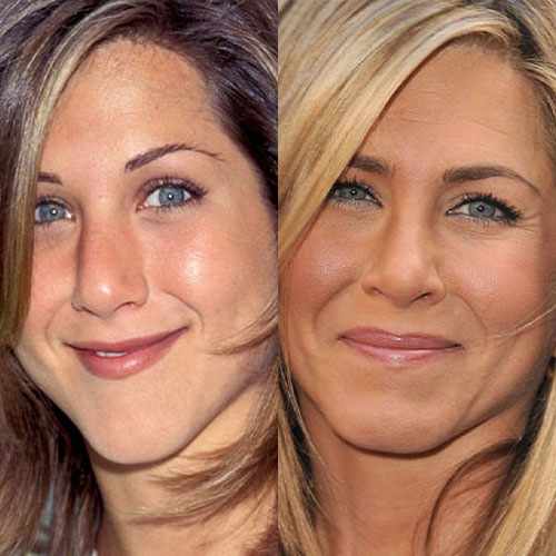 jennifer aniston burun estetigi