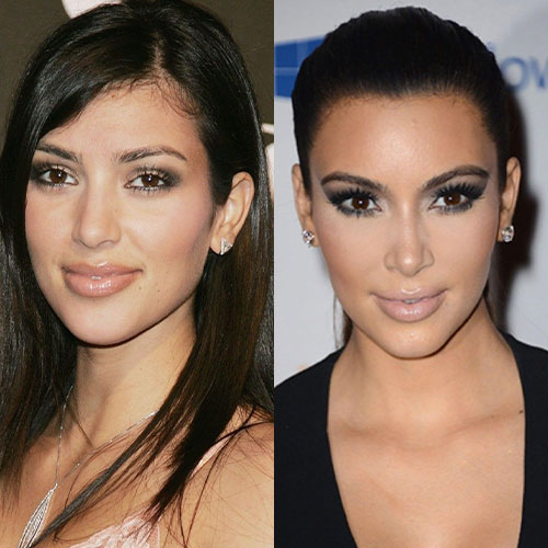 kim kardashian burun estetigi