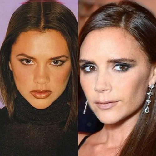 victoria beckham burun estetigi