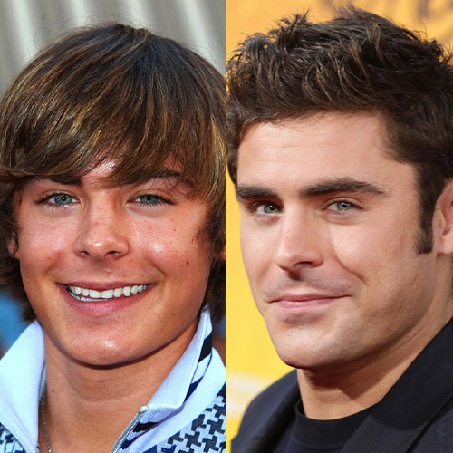 zac efron burun estetigi